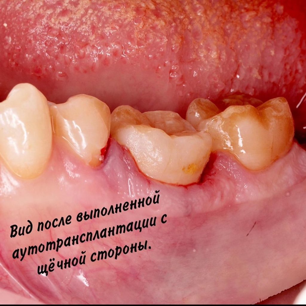 Пересадка зуба (Галерея улыбок, Оскар Раисович Асватуллин)
