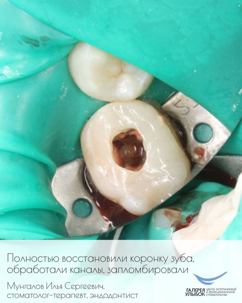 Эндодонтическое лечение каналов. Галерея улыбок, стоматология в Красноярске