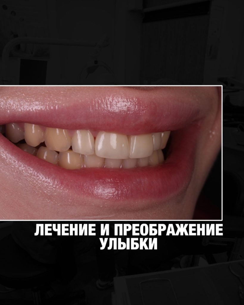 Две керамические реставрации во фронтальной зоне