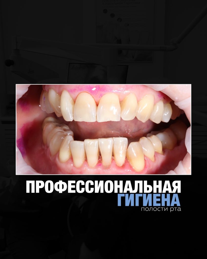 Профессиональная гигиена полости рта