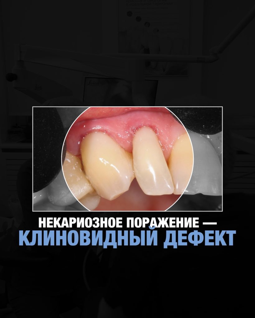 Клиновидный дефект: не кариес, но требует точного подхода