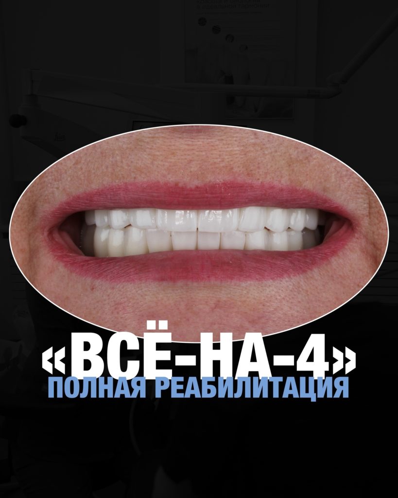 Всё-на-4: полная реабилитация