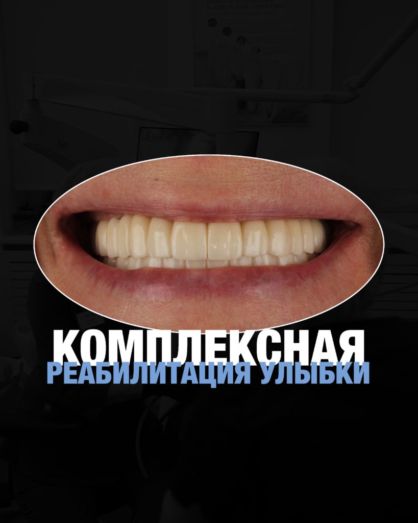 Полная реабилитация по протоколу «All-on-6»